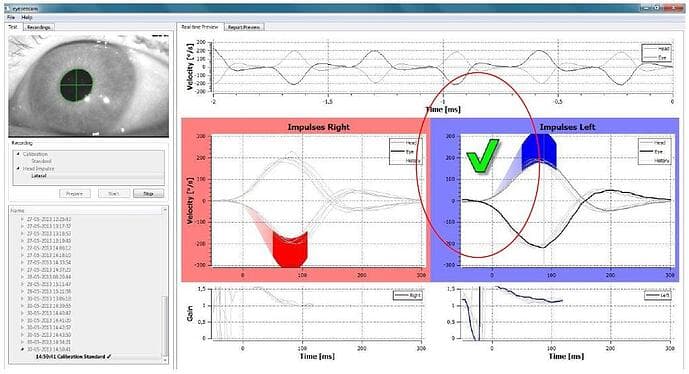 Hyperfunction Vhit vHIT: A Comprehensive Overview | e3 Diagnostics